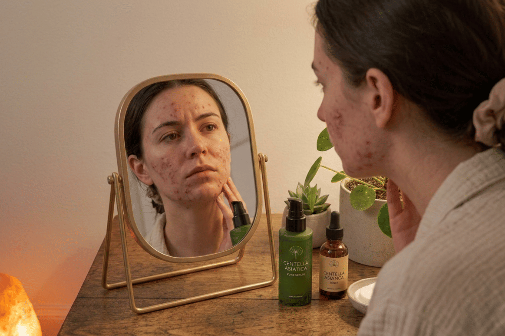 Kandungan Skincare Malam yang Wajib Digunakan untuk Kulit berjerawat