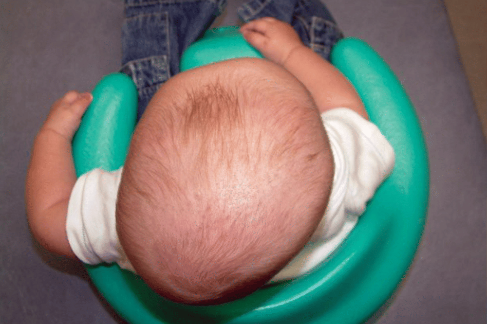 Apa Itu Plagiocephaly?