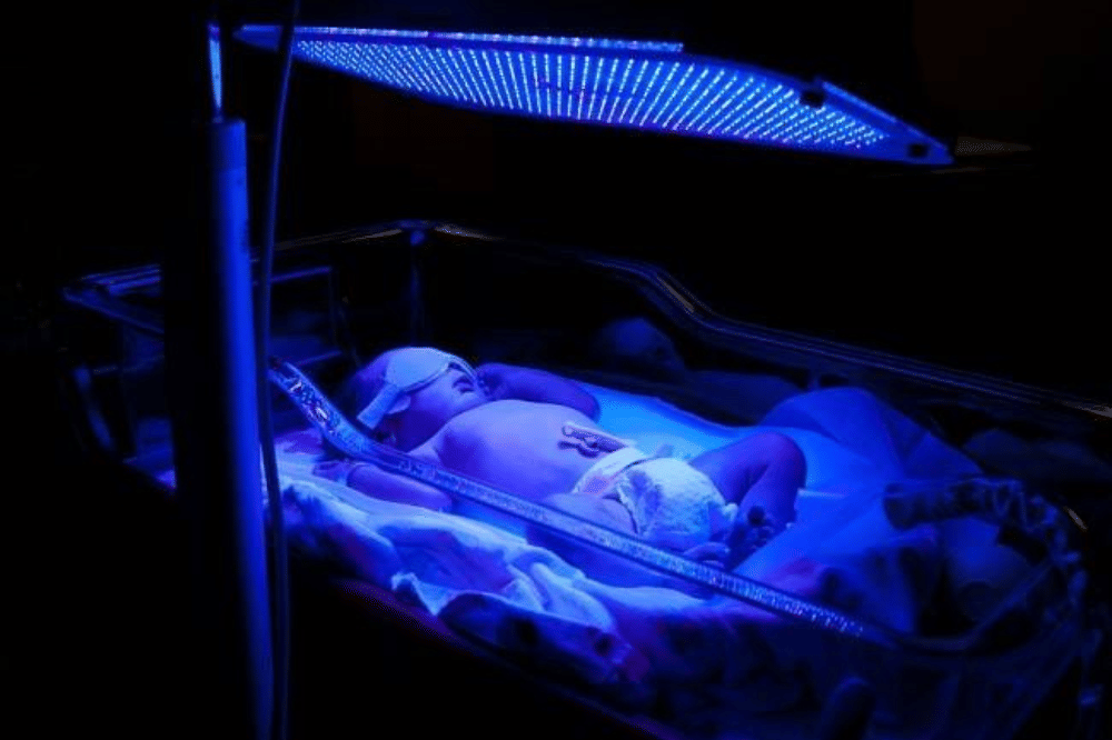 Cara Menangani Ikterus Neonatus pada Bayi