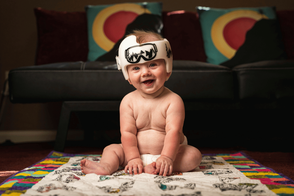 Apakah Plagiocephaly Bisa Sembuh?