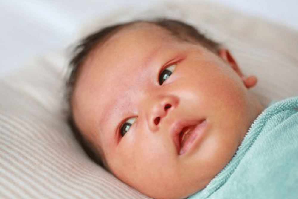 Apa Itu Ikterus Neonatus pada Bayi? 