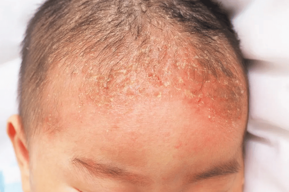 Perbedaan Tampilan Cradle Cap dan Ketombe Bayi