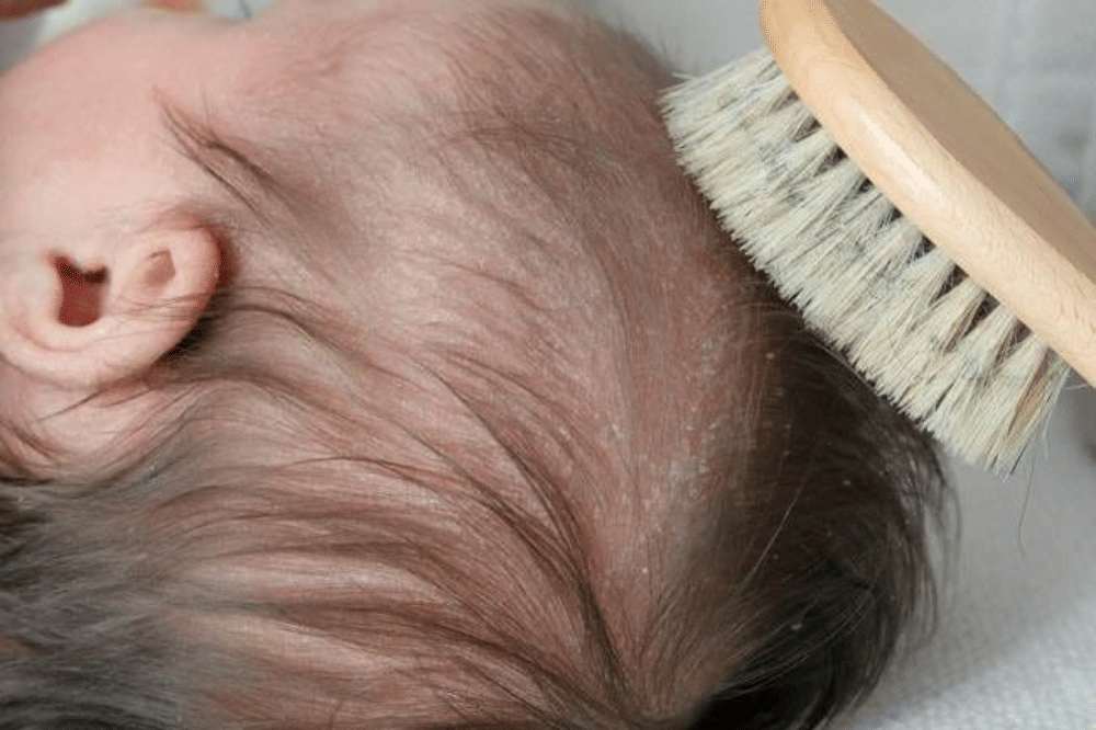 Perbedaan Penanganan Cradle Cap dan Ketombe Bayi