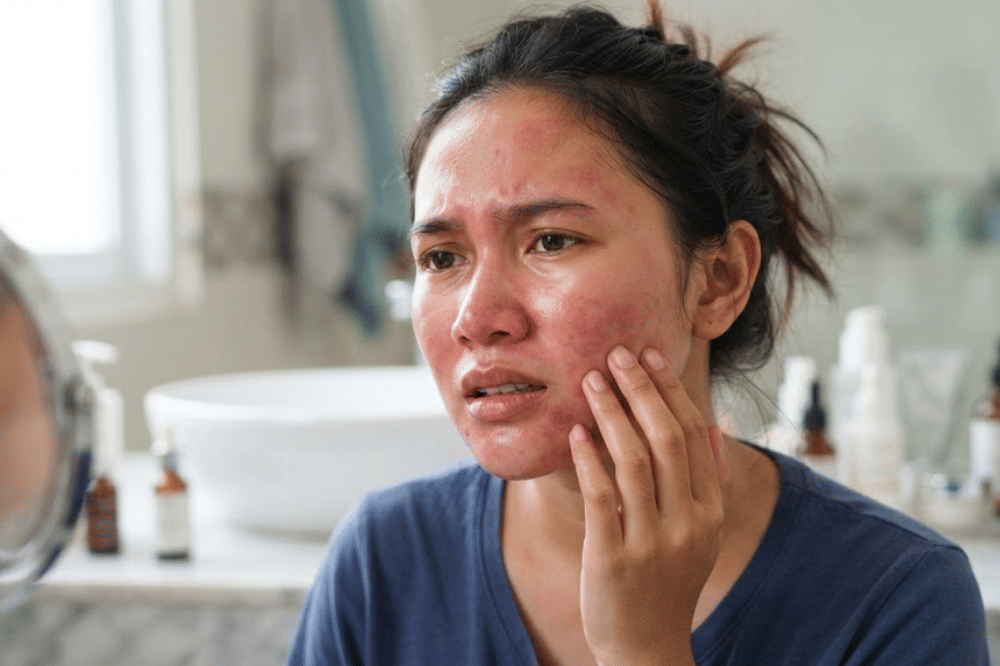 Wajah Terasa Perih setelah Pakai Skincare, Waspadai Skin Barrier Rusak