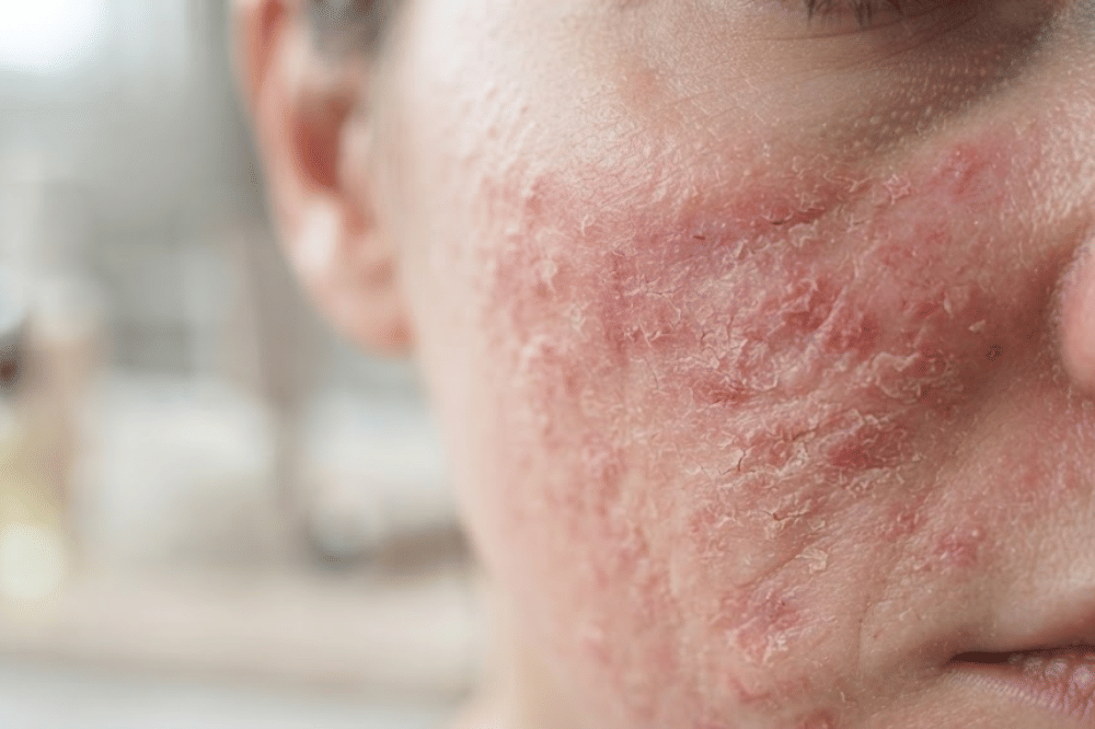 Lapisan skin barrier yang rusak