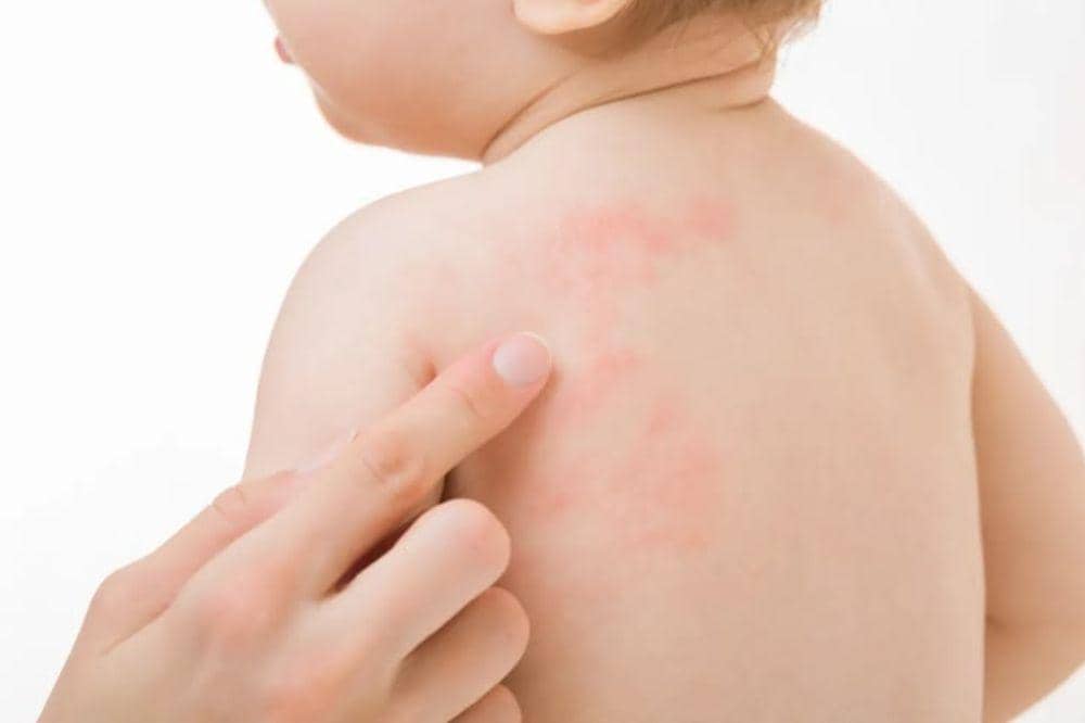 Benarkah Anak Dermatitis Atopik Harus Pantang Banyak Makanan?