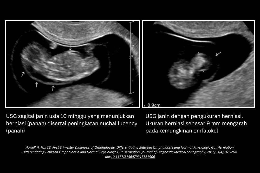 Skrining perut janin