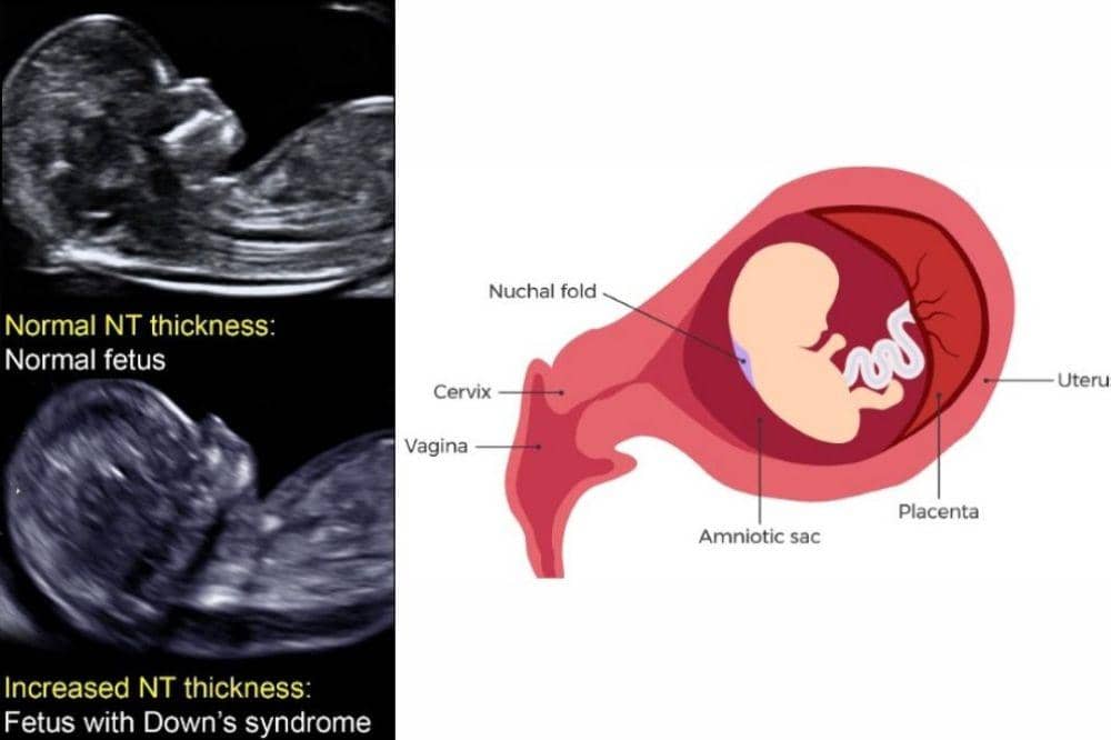 Skrining nuchal tranlucensy