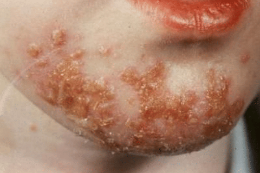 Impetigo pada anak