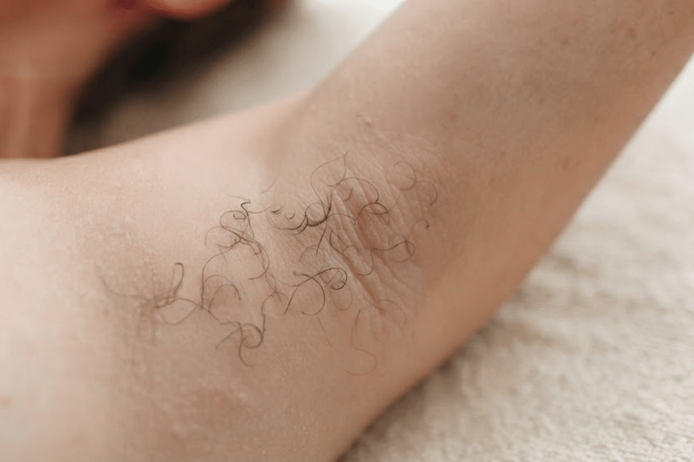 Risiko ingrown hair yang bikin tekstur makin kasar