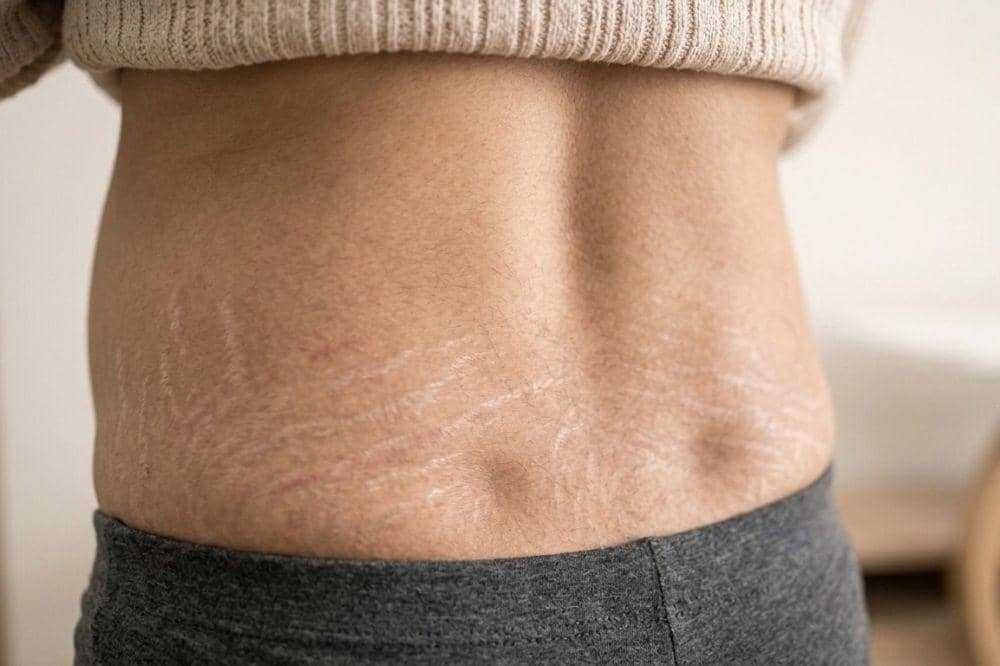 Bagian tubuh ibu hamil yang sering mengalami stretch mark