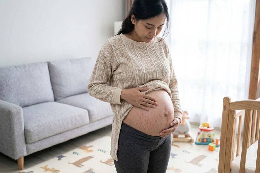 Di Usia Kehamilan Berapa Stretch Mark Mulai Muncul? Begini Fasenya