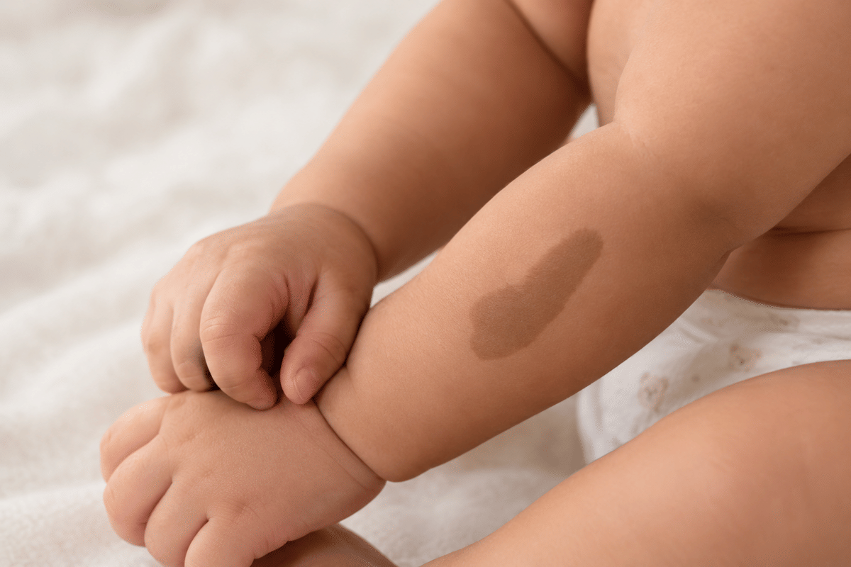 Bercak cokelat seperti kopi susu di tubuh anak, apakah berbahaya?