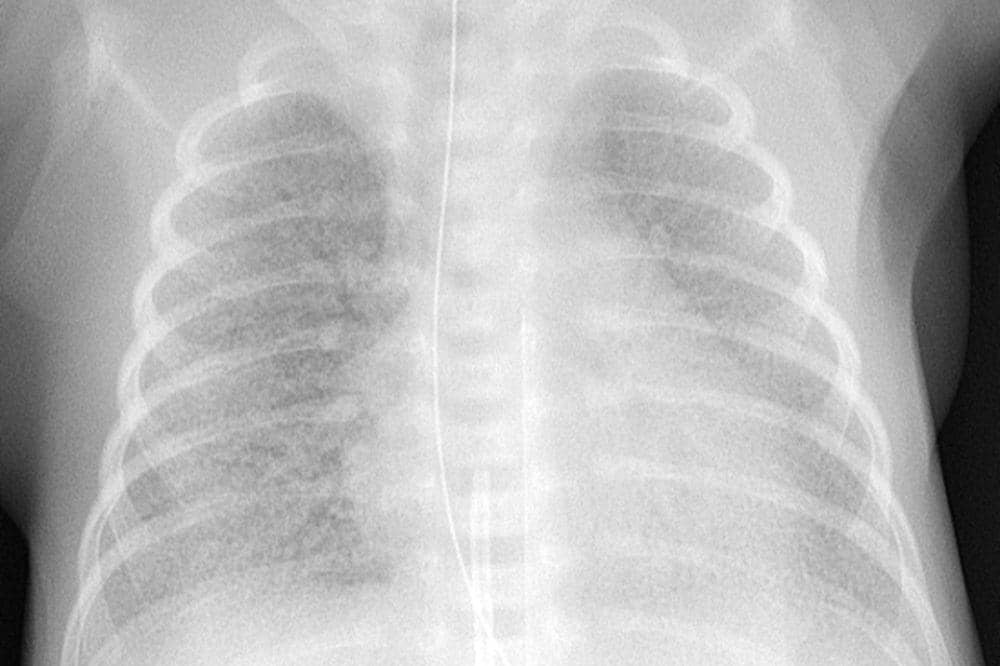 Cara Diagnosis Respiratory Distress pada Bayi