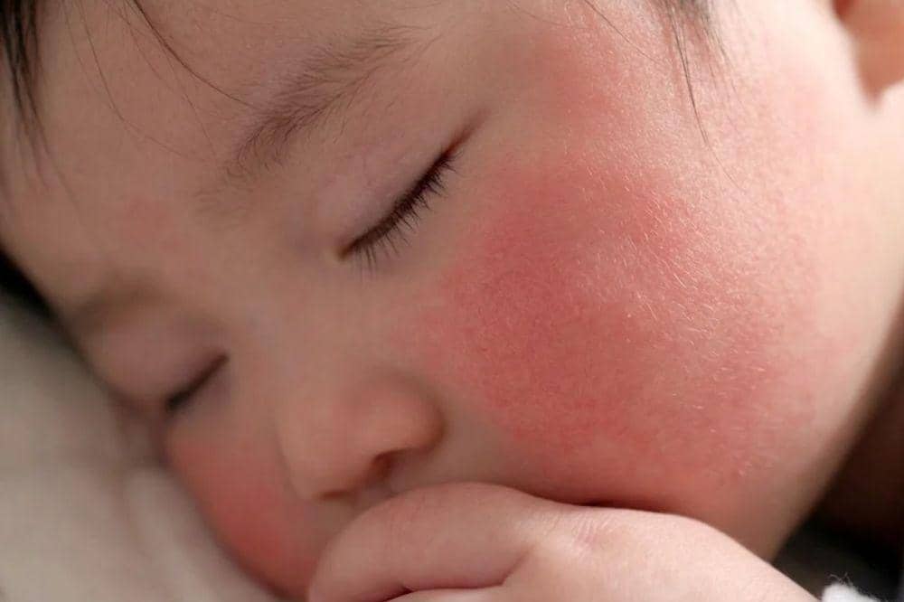 Gejala alergi susu sapi pada bayi
