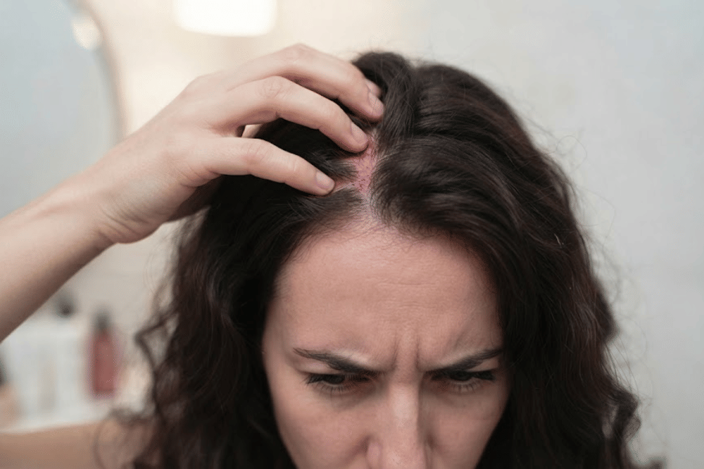 Nyeri kulit kepala menandakan folikel rambut teriritasi