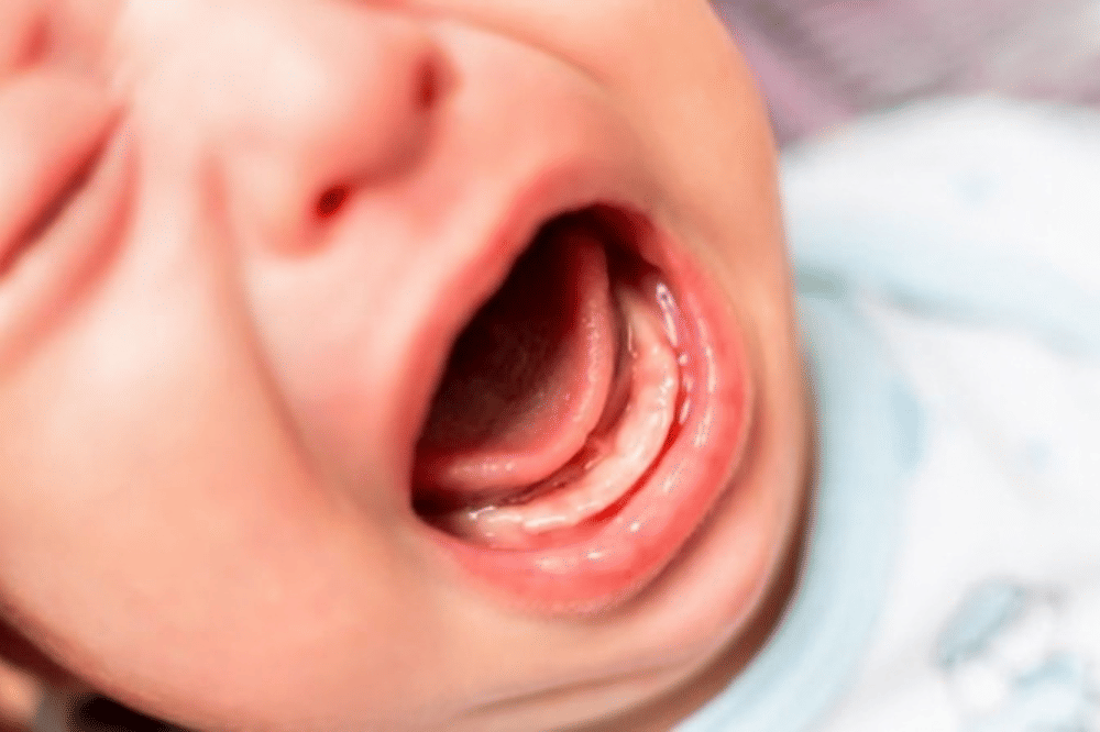 Gusi Putih pada Bayi Pertanda Apa?
