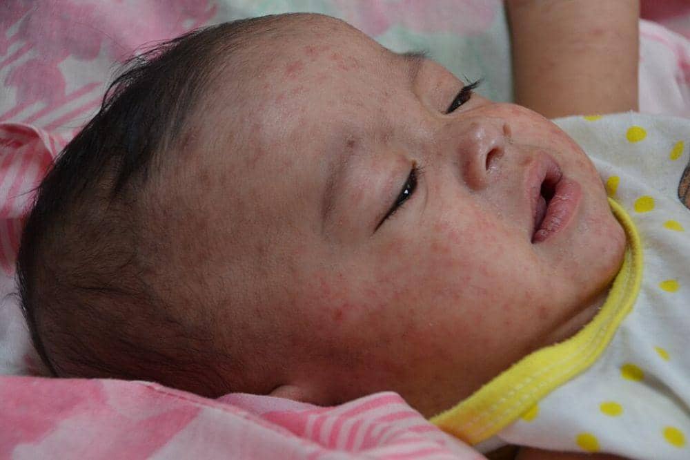 Muncul ruam atau bintik merah
