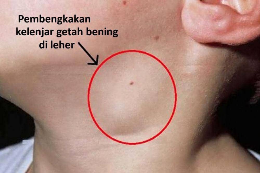 Benjolan di Leher Anak, Bisa Jadi Pembengkakan Kelenjar Getah Bening