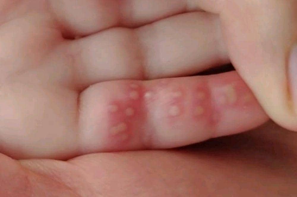 Bagaimana Cara Mengatasi Bentol Berair pada Kulit Bayi?