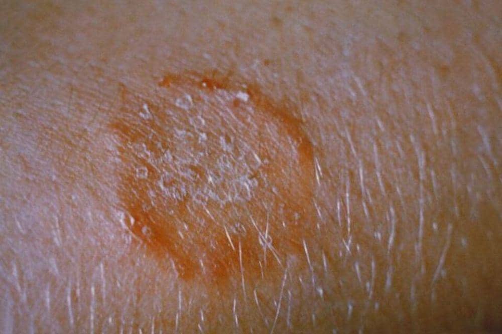 6 Penyebab Kurap pada Bayi, Mengelus Hewan Salah Satunya