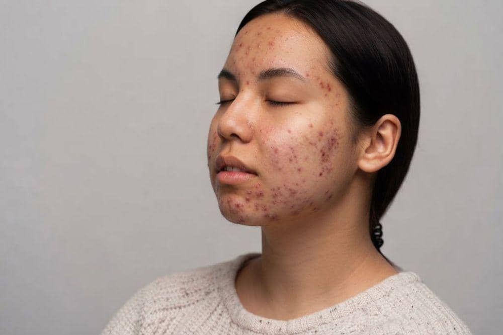 Penyebab flek hitam di wajah saat hamil
