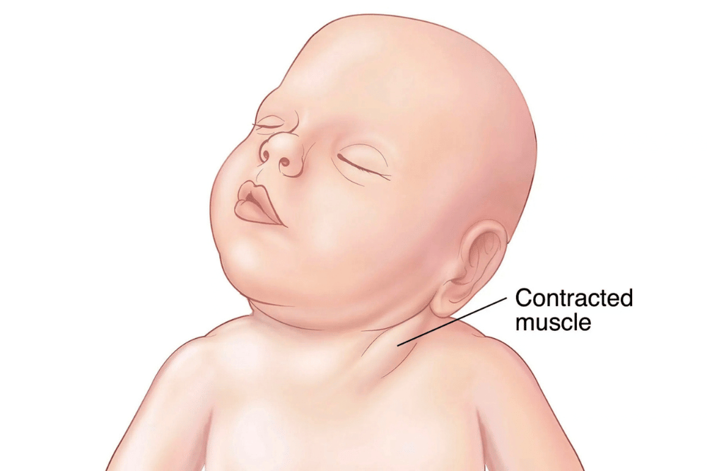 Apa Itu Tortikolis pada Bayi?