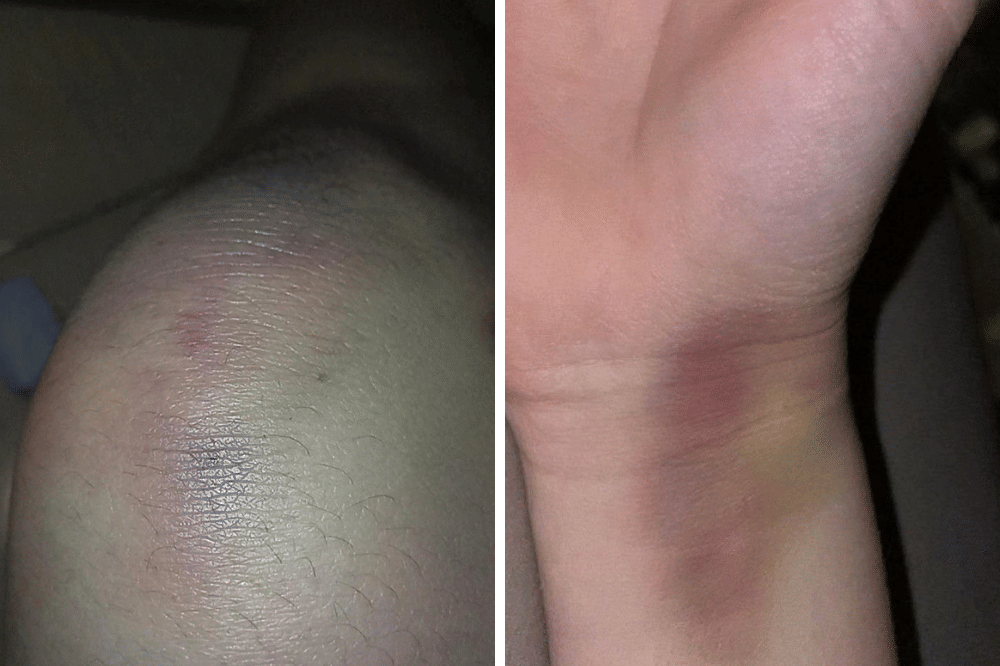 Luka lebam pada kaki dan tangan