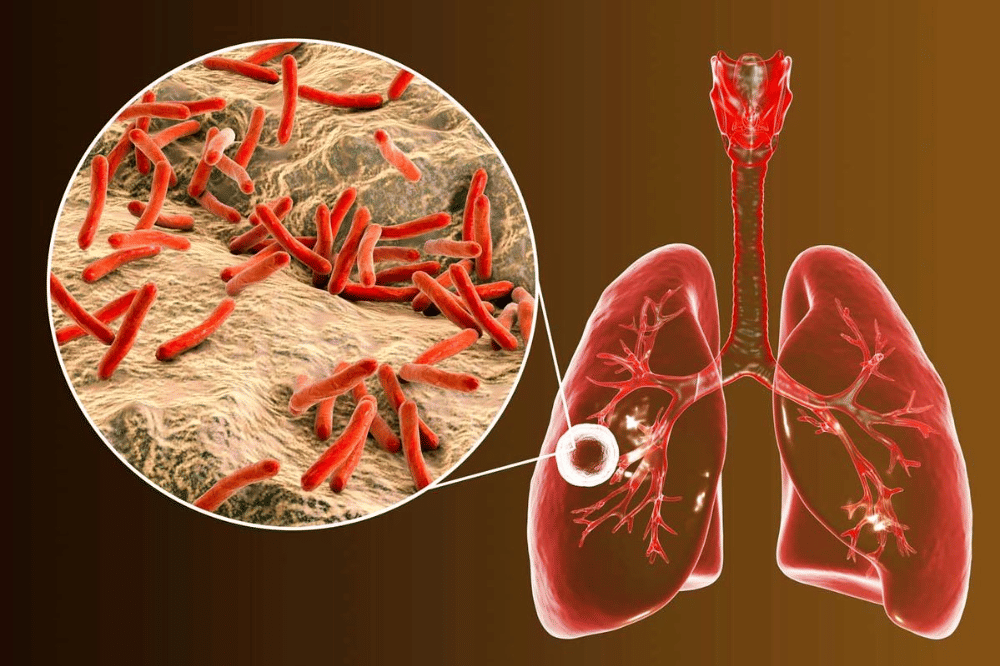 Tuberkulosis (TBC)