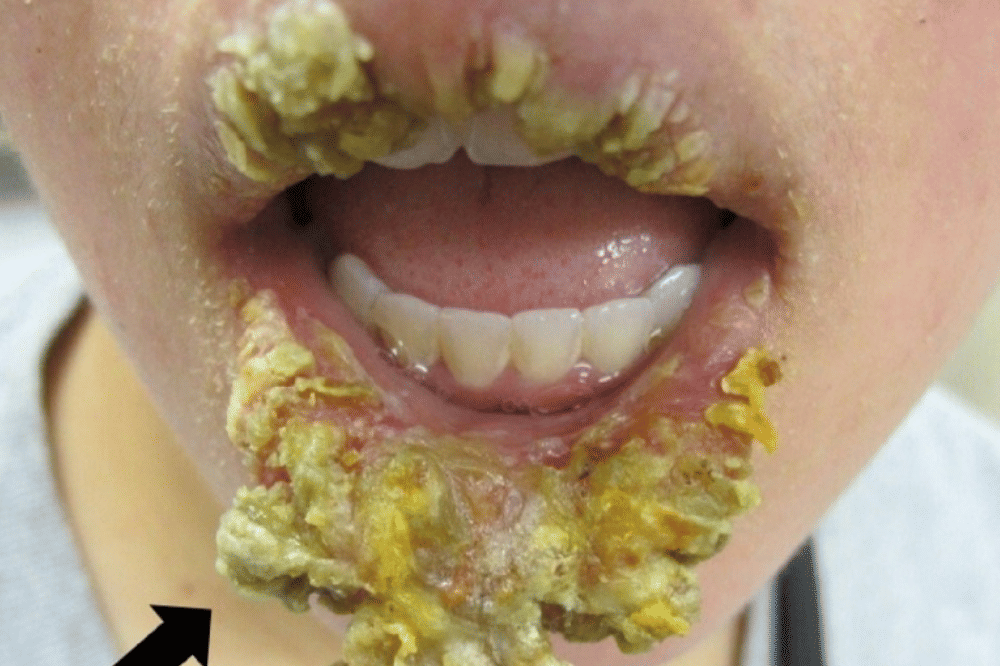 Factitial Cheilitis dan Pengaruh Kondisi Psikologis