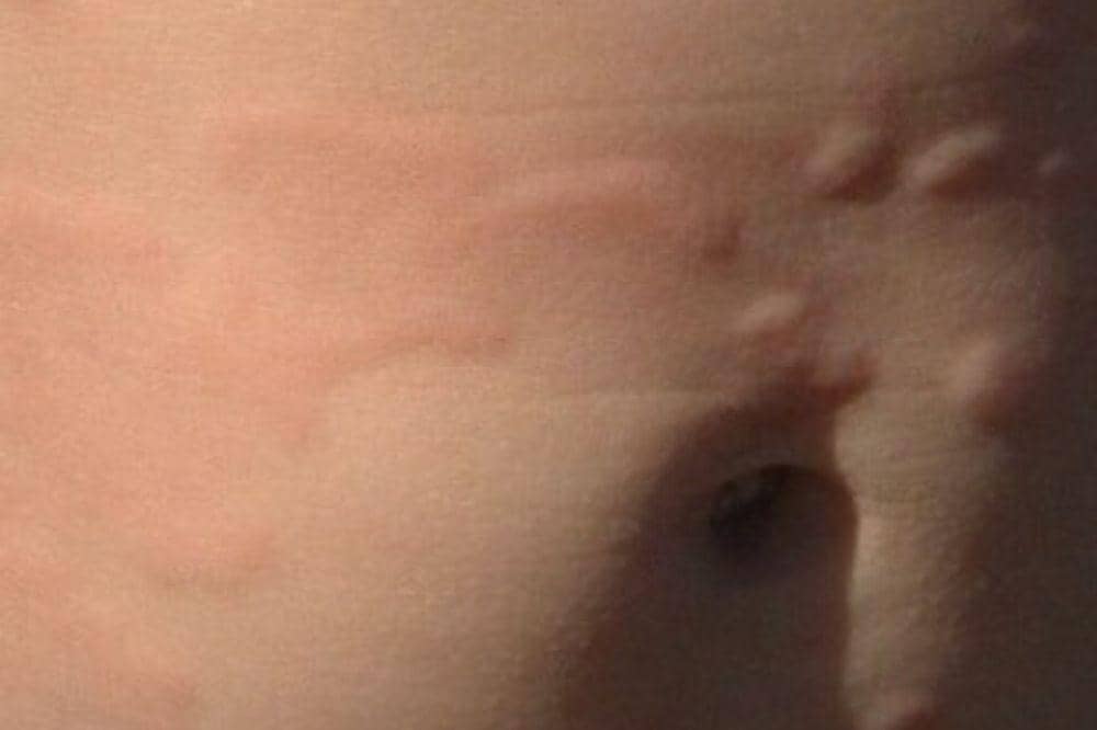 Apa Penyebab Bayi Mengalami Biduran?