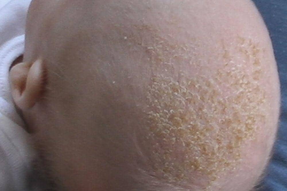 Dermatitis seboroik