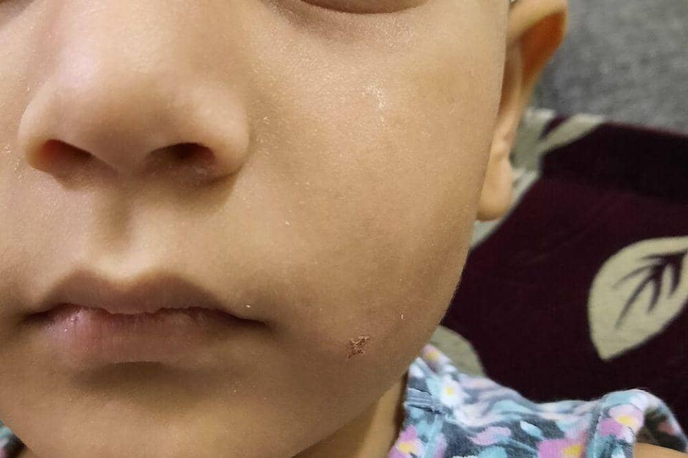 Infeksi kulit