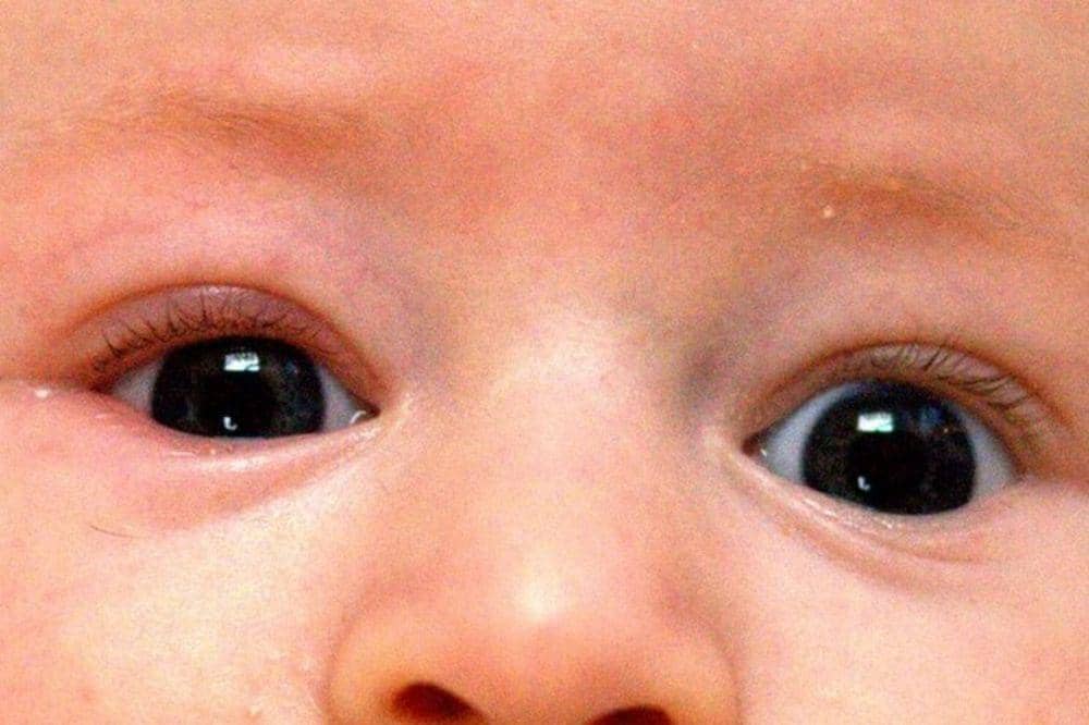 Apa Itu Blefaritis pada Bayi? Kenali Gejala dan Penanganannya