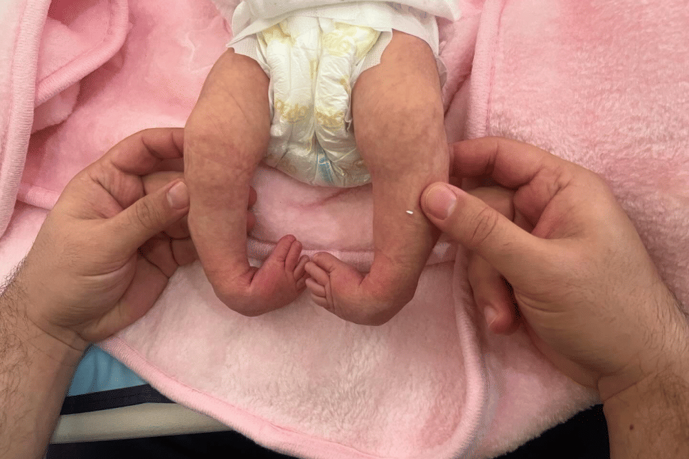Clubfoot pada Bayi: Apa Itu, Penyebab dan Cara Mengatasinya