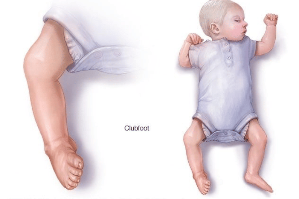 Apakah Clubfoot Bisa Sembuh? Ini Penjelasannya!
