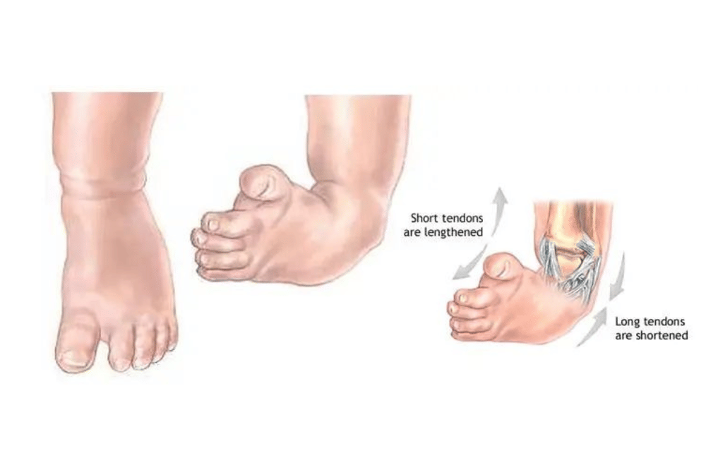 Clubfoot bisa sembuh dengan penanganan yang tepat