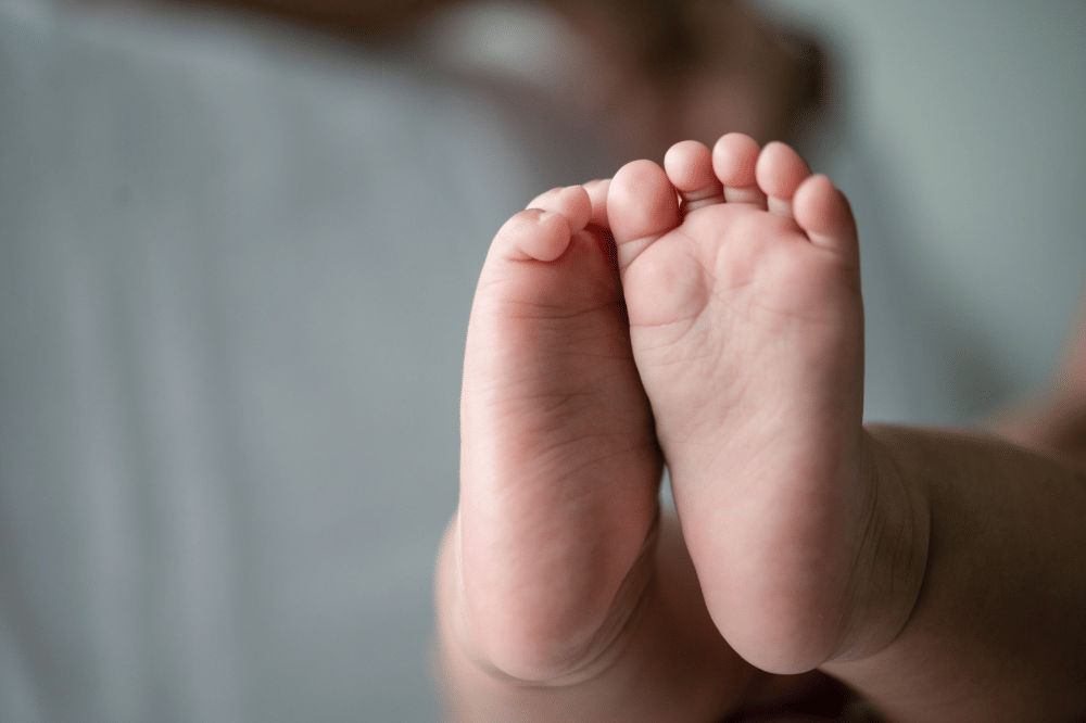 Penyebab clubfoot belum diketahui secara pasti