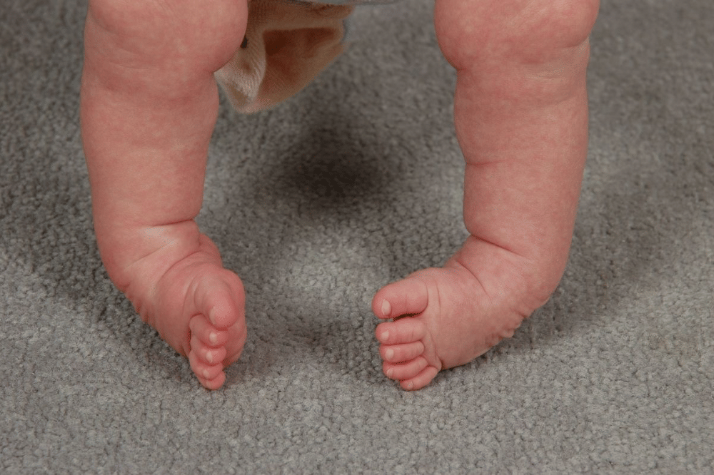 Apa itu clubfoot pada bayi?