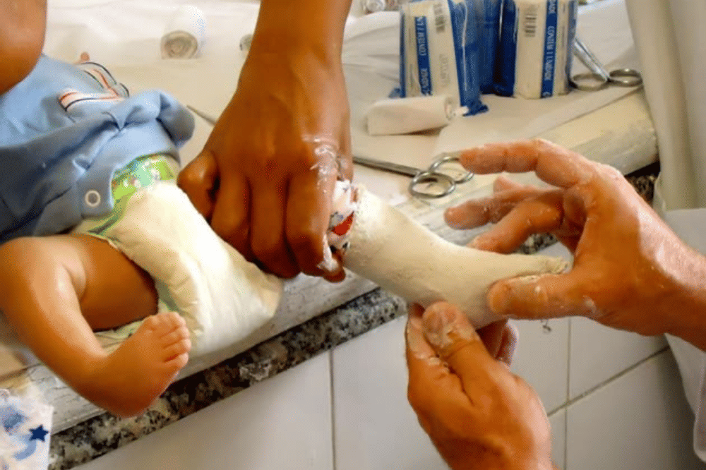 Bagaimana cara mengatasi clubfoot pada bayi?