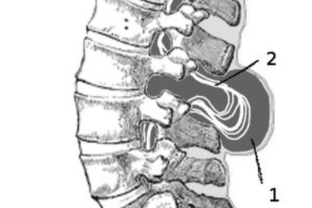 Apa Saja yang Menyebabkan Spina Bifida pada Bayi?