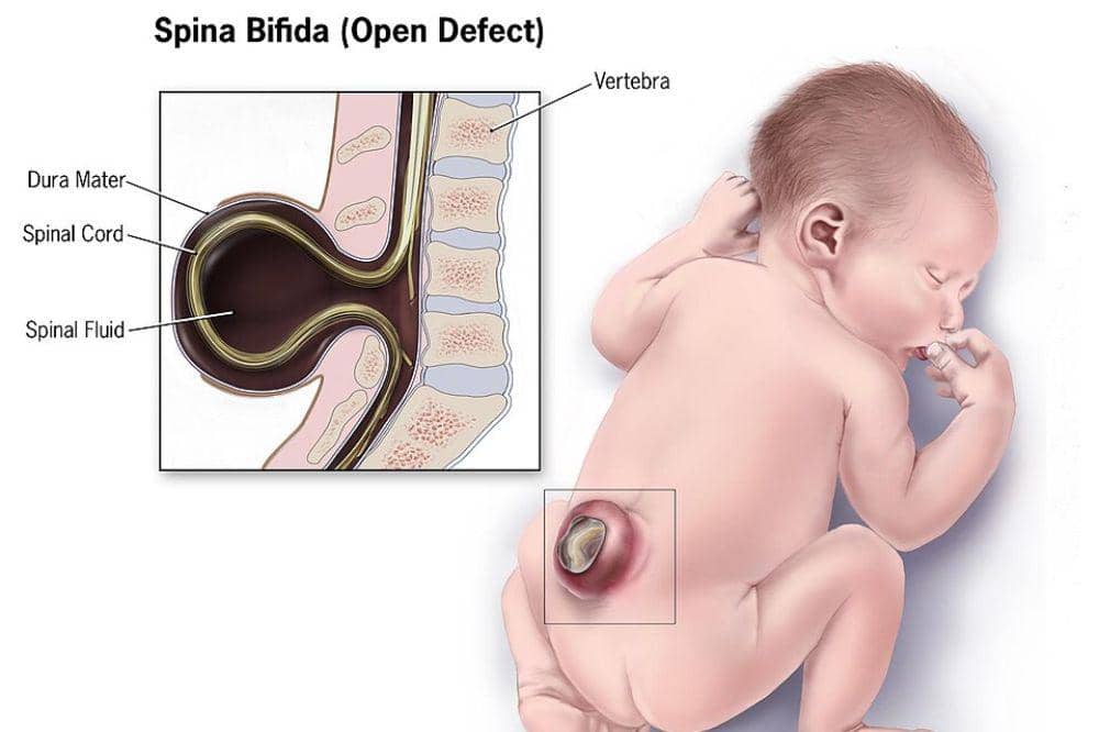 Apa yang Menyebabkan Spina Bifida pada Bayi?