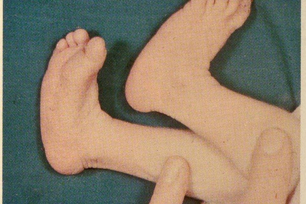 Gejala Sindrom Edward pada Bayi