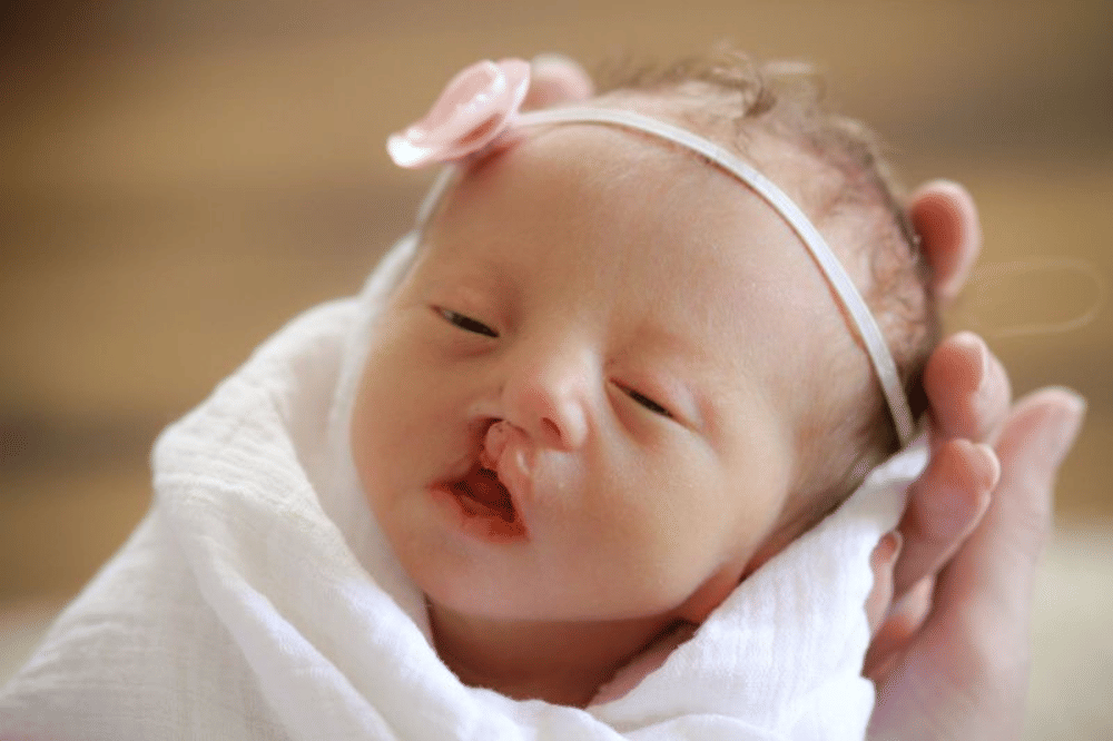 Apa Itu Sindrom Patau pada Bayi? Ini Penjelasannya