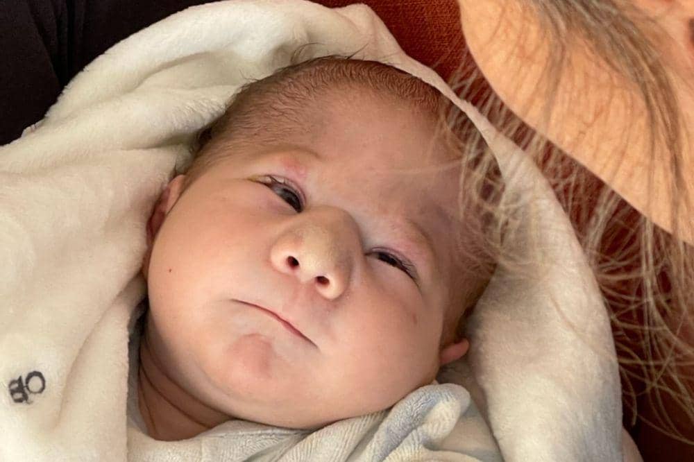 Apa Saja Ciri-Ciri Sindrom Patau pada Bayi?