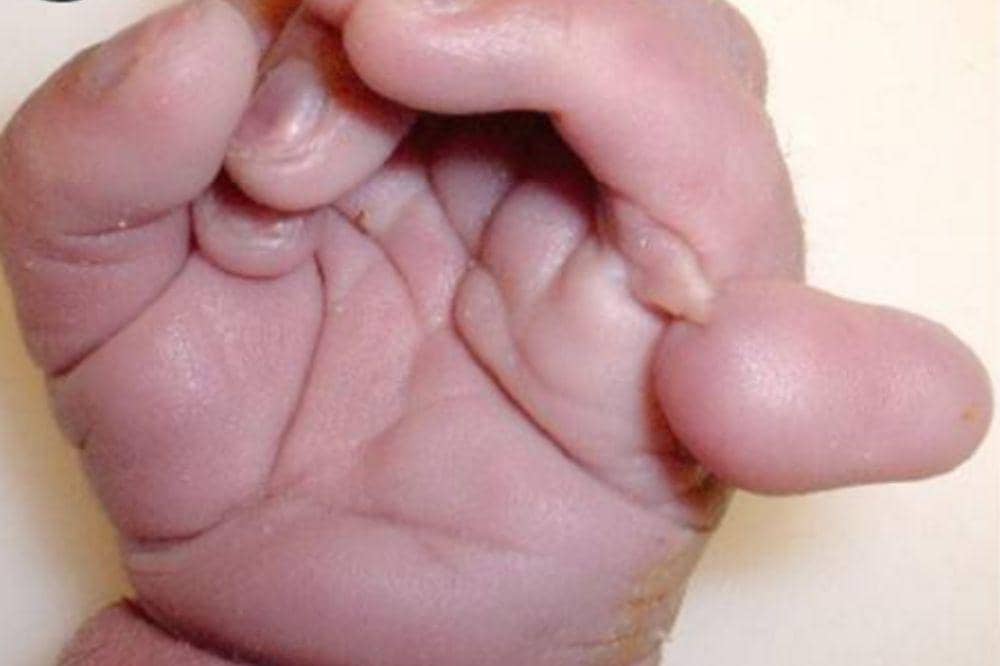 Apa Saja Ciri-Ciri Sindrom Patau pada Bayi?