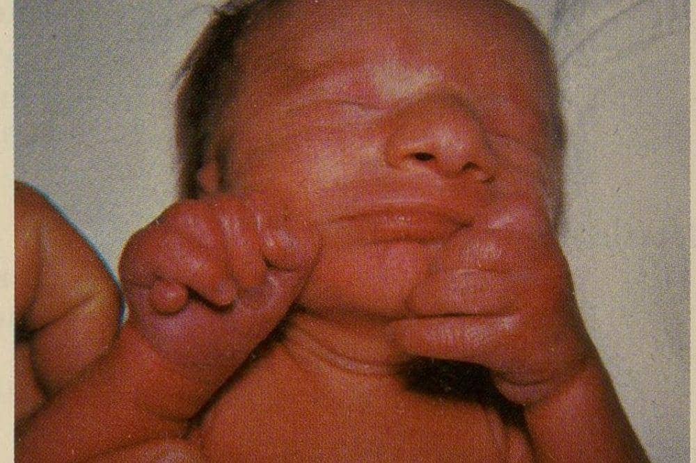 Apakah Sindrom Patau pada Bayi Bisa Diobati?