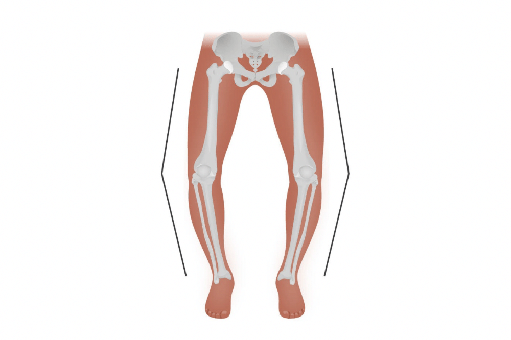 Kaki O (Bow Legs)