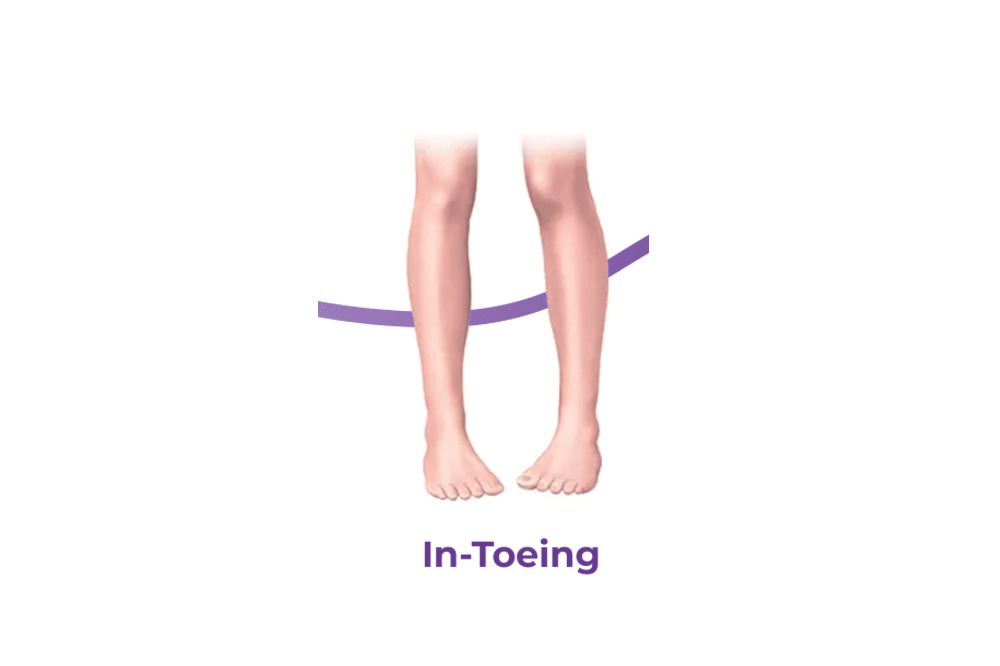 Kaki Menghadap ke Dalam (In-toeing)
