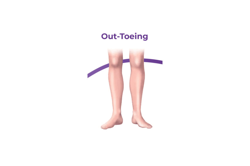 Kaki Menghadap ke Luar (Out-toeing)